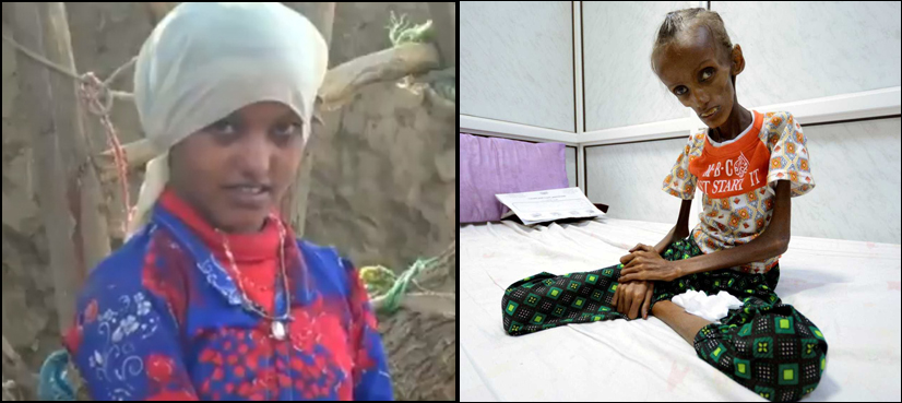 Yemen malnutrition