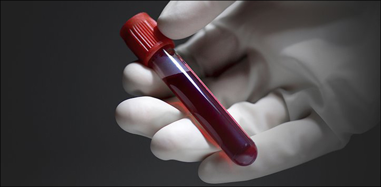 melanoma blood test