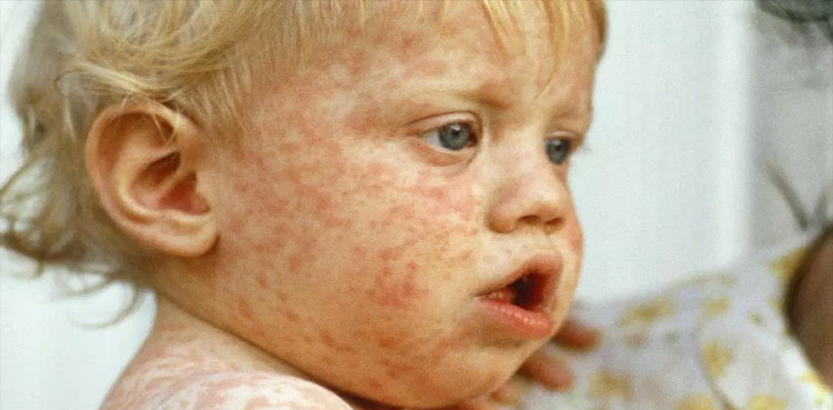 US measles outbreak, two children die, 650 ill