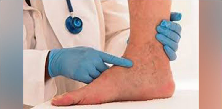 varicose veins