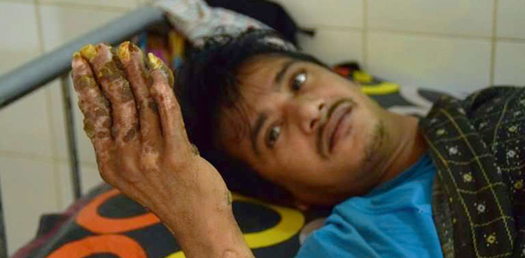 Bangladesh, tree man, abul bajandar,