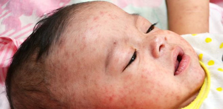 17 children die, Sindh, measles