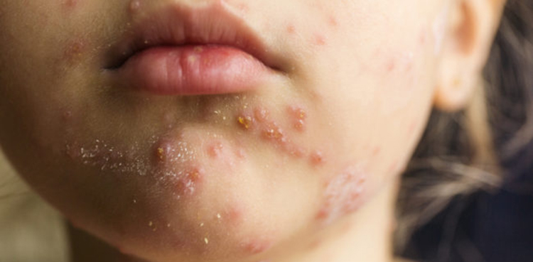 Measles cases on rise, Karachi, health officials