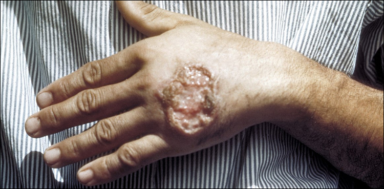 Leishmania, WHO