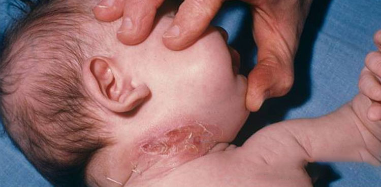 Badin diphtheria deaths, 15 children die