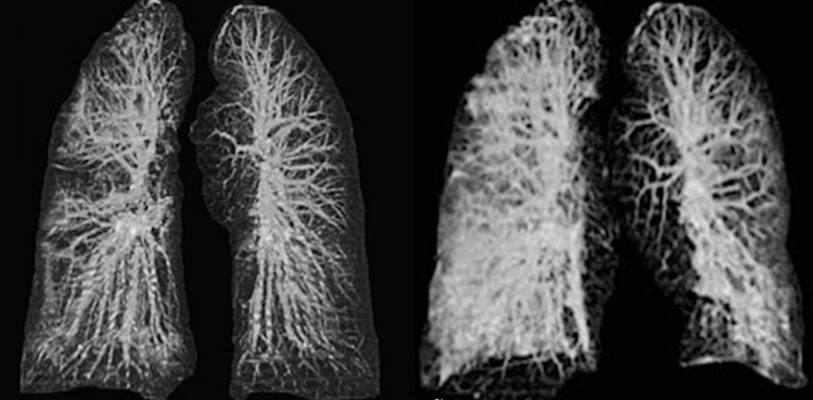coronavirus lungs