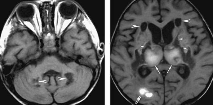 Brain damage, coronavirus