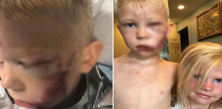 six-year-old-boy stitches