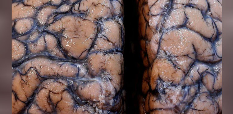 COVID-19 brain