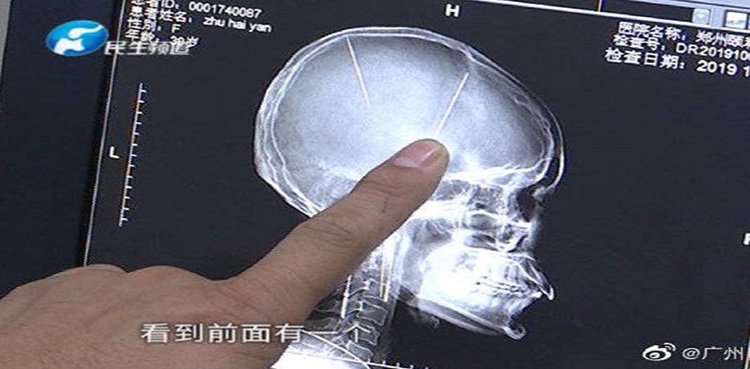 needles-in-woman-brain-ct scan-shocking