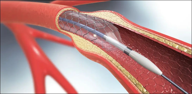 Expired cardiac stents-Punjab, Punjab, Punjab institute of cardiology , PIC