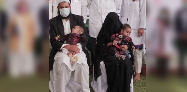 conjoined twins, surgery, operation, Karachi