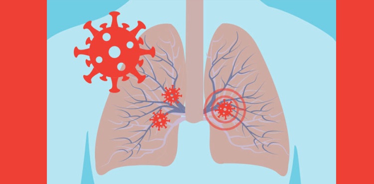 coronavirus lungs