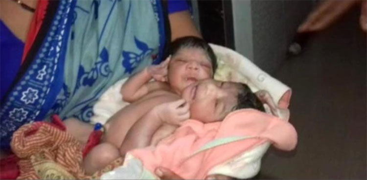 conjoined twins, woman, birth, three arms, two heads