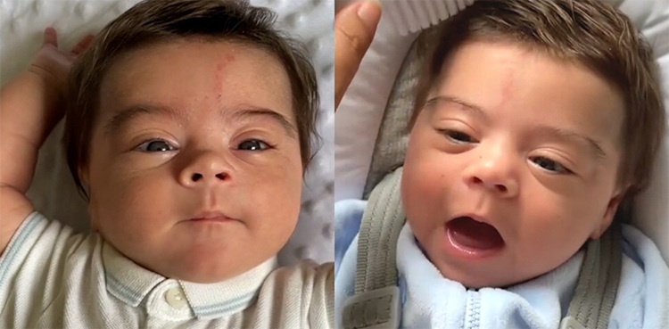 newborn baby, thick hair, rare condition, sugar