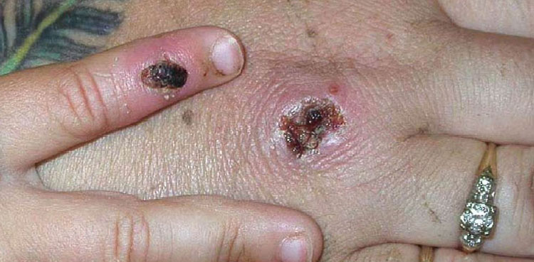 rare virus england monkeypox cases smallpox imnavex