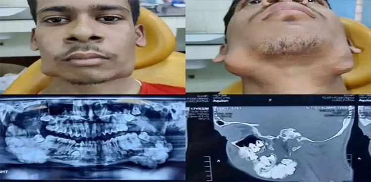 teeth-rare-surgery-case-removed-medical-condition