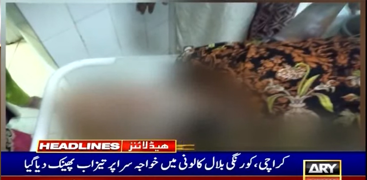 TW-Horrific-acid-attack-on-Karachi-transgender-causes-60pc-body-burns