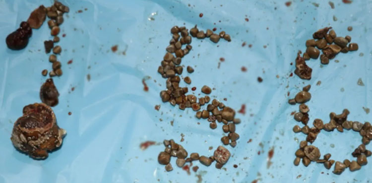 Hyderabad kidney stones patient