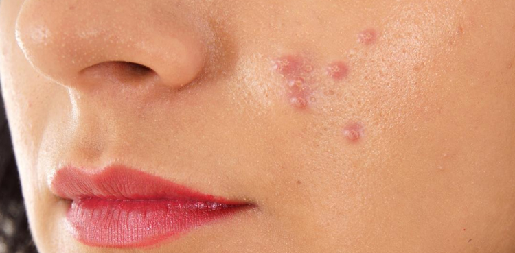 pimples, remedy, pimples on our face, remedies