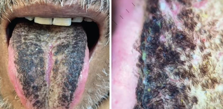 hairy tongue, Indian Man, Special diet, black hairy tongue