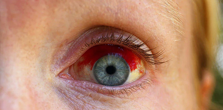 eye clots COVID-19