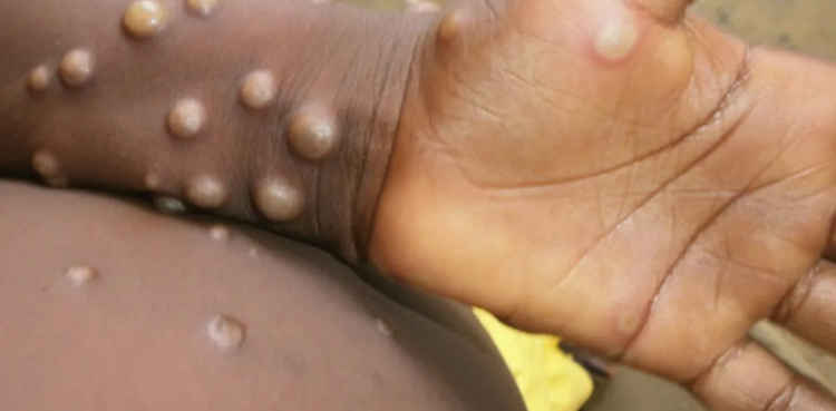 monkeypox virus, Spain, second case