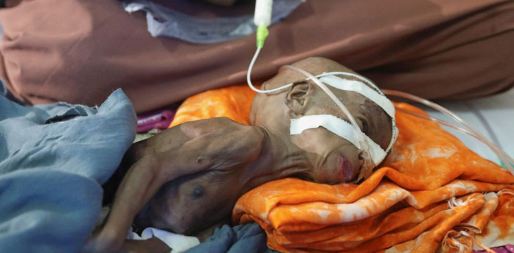 Somalia malnutrition famine