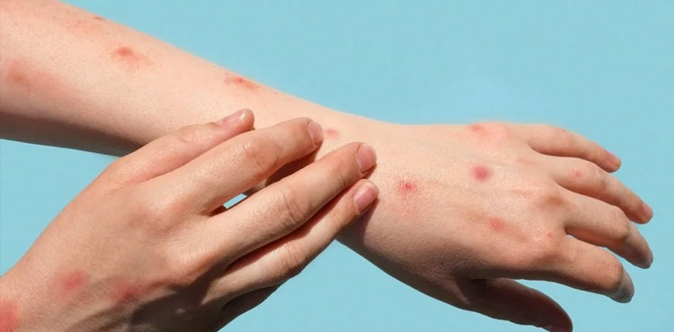 mpox , Frist case, Karachi