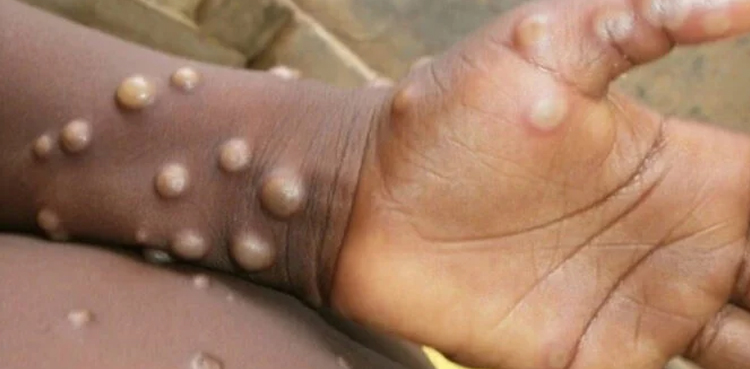 Monkeypox UNICEF emergency vaccine