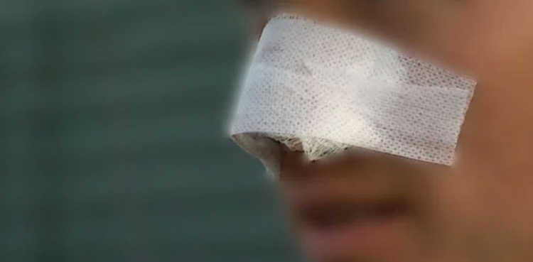 Husband cuts off wife's nose, sharp weapon