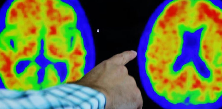 acumen Alzheimer safety test