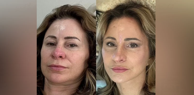 woman-facelift-surgery-sells-house