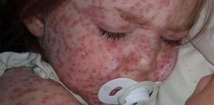 chicken pox, virus outbreak, high alert on hospitals