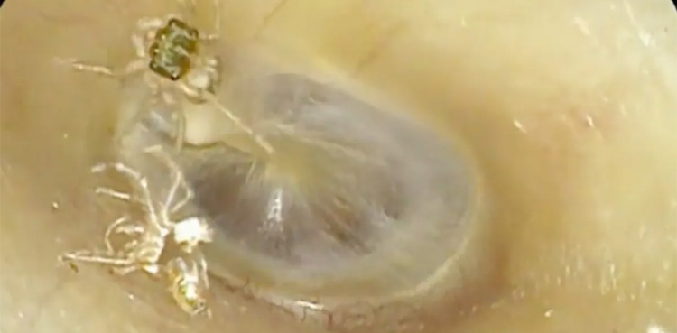 Spider in ear, Abnormal Sounds, viral video