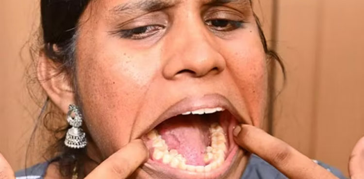 Indian woman 38 teeth, Kalpana Balan, Guinness World Record