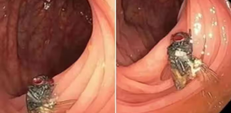 man’s intestines, Viral, house fly,