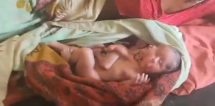 baby with four legs four arms two faces