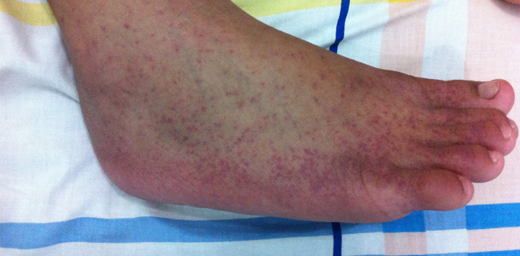 Chikungunya cases, Dengue cases, Karachi
