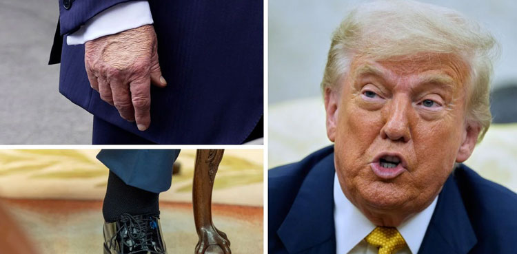 Donald-Trump,-US-president,-venous-insufficiency,-White-House