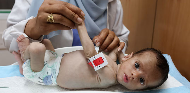 Gaza malnutrition, child arm, mother thumb