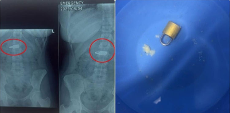 laparoscopic, Lock, stomach, Lyari Hospital